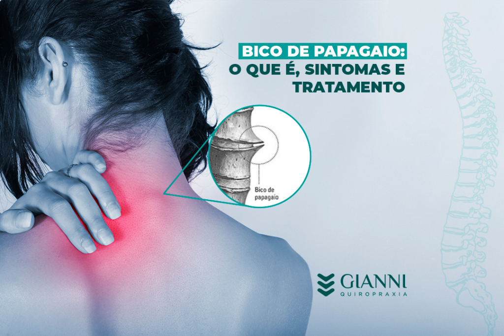 Imagem exemplificativa sobre bico de papagaio