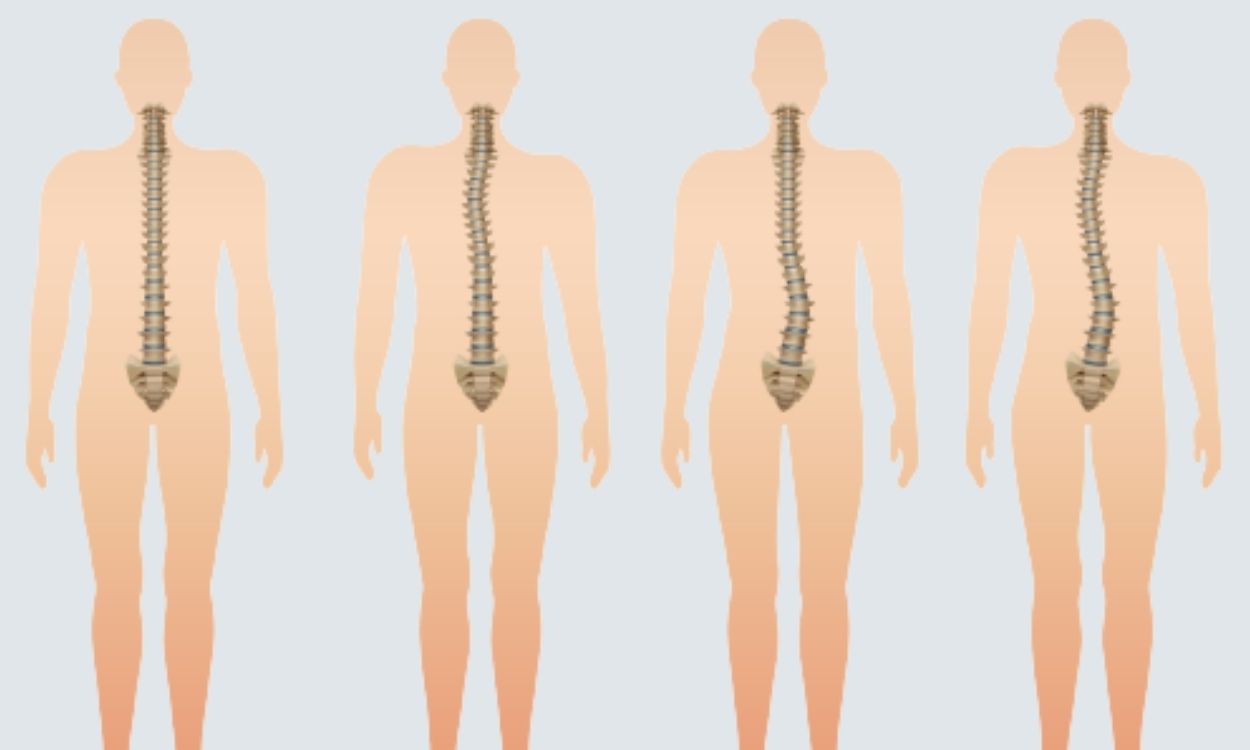 Médico explica: Escoliose, mais do que viver com a coluna aos 'ésses